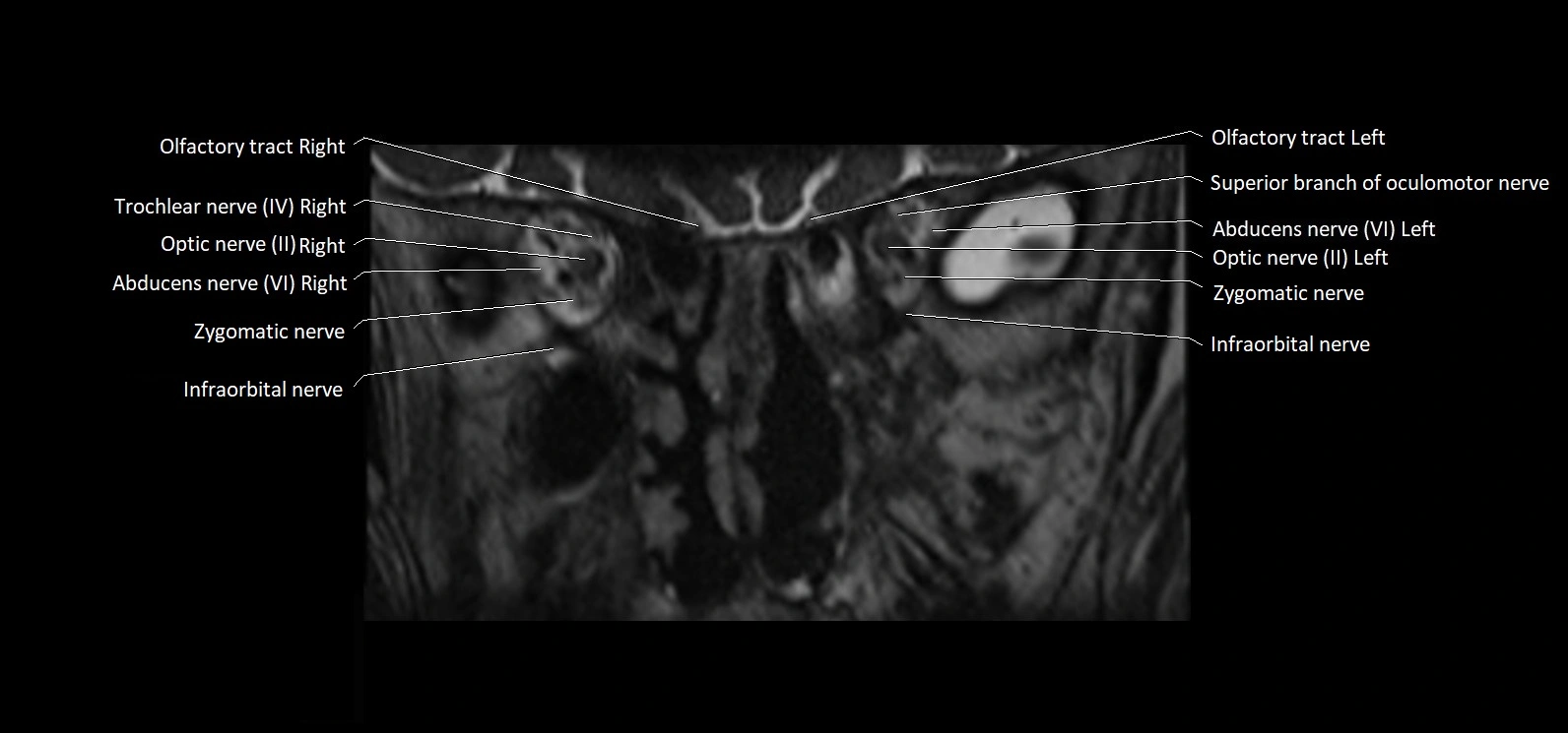 Cranial nerve cross sectional anatomy coronal 3T MRI image 12.webp